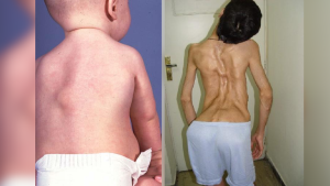 Stone Man Syndrome (Fibrodysplasia Ossificans Progressiva): Understanding a Rare Condition