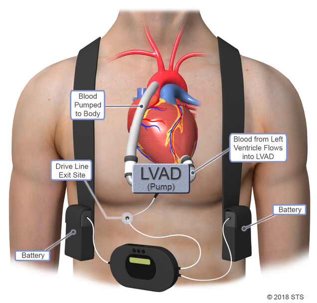 How LVAD Surgery Can Improve Heart Function