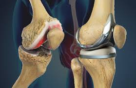 Everything You Need to Know About Knee Replacement Surgery